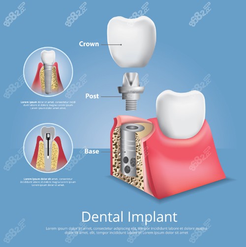 种植牙构成图