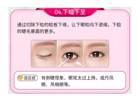 為什么醫(yī)生不建議做眼瞼下至 為什么醫(yī)生不建議做眼瞼下至
