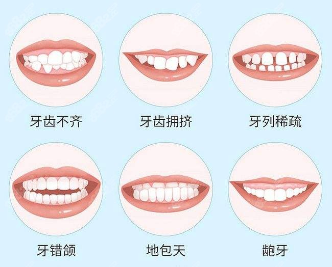 佛山登特牙齿矫正类型