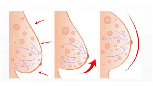 乳房下垂矫正矫正对比