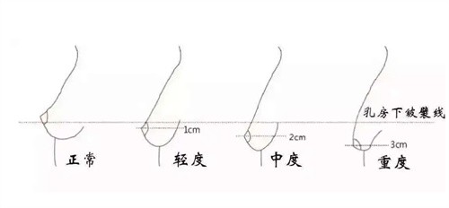 胸部下垂程度视下皱襞与乳房下级的关系而定