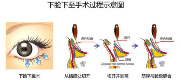 北京眼睑下至手术医院及医生排名推荐8682.cc
