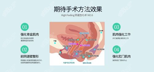 韩国如妍妇科缩阴手术方法与韩国好手艺不同.jpg