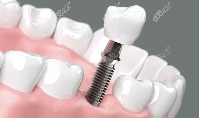 种植牙将被再生牙取代的消息不可靠