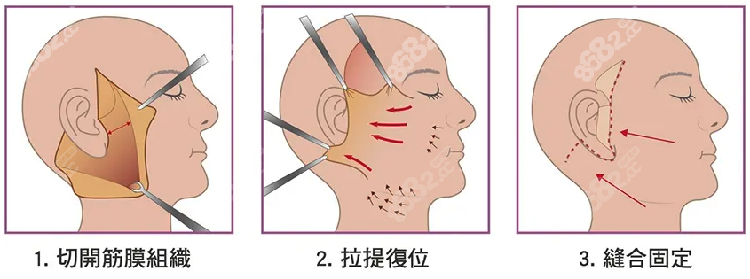 西安拉皮手术排名前十公示www.8682.cc