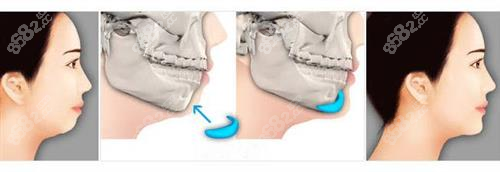 假体垫下巴手术过程8682.cc