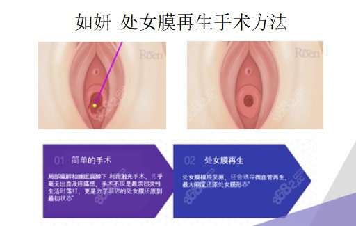 韩国如妍妇科私密医院处女膜修复价格