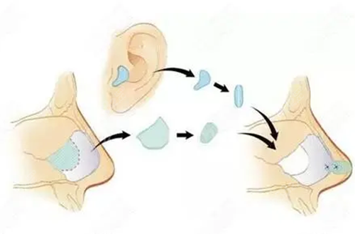 耳软骨隆鼻能改善鼻头吗？