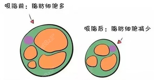 张怀军医生做吸脂手术真的不错