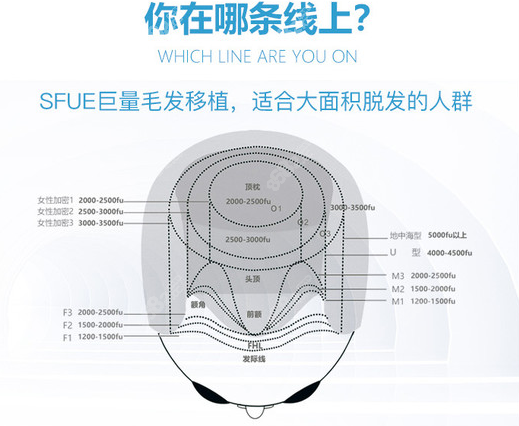 熙朵脱发治疗面积图