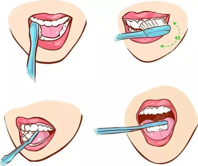 牙齿贴面后要注意刷牙护理事项