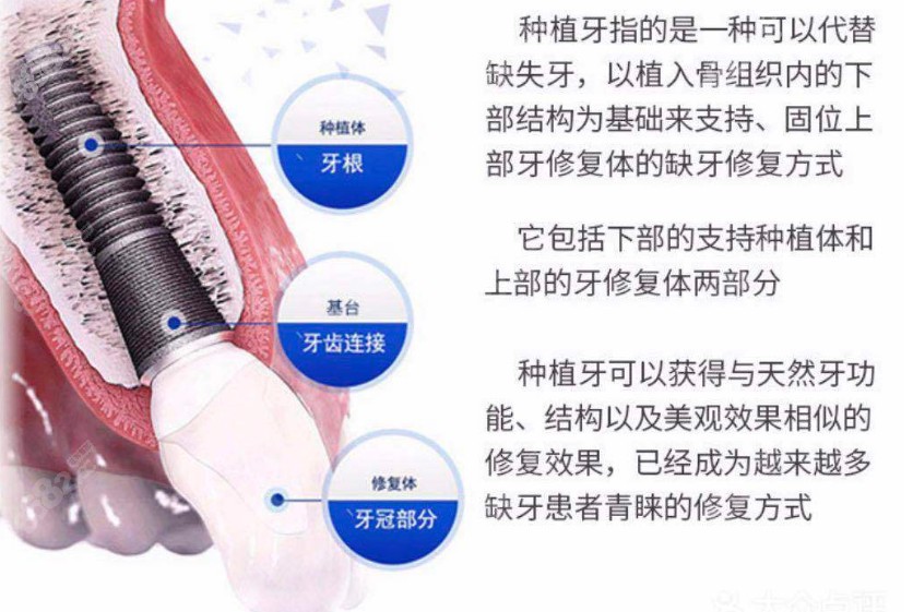 邳州种植牙价格表