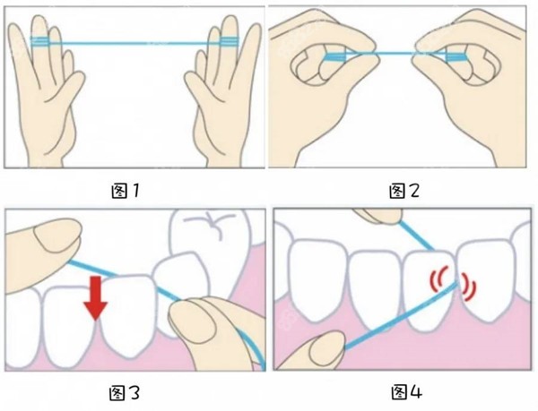 牙齿贴面后要注意牙线的使用