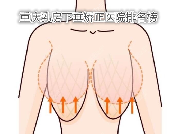 重庆乳房下垂矫正医院排名榜