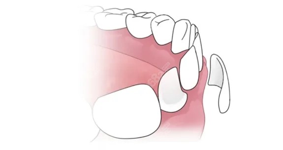 牙齿贴面正常现象8682