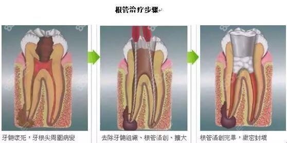 牙髓炎的治疗方式做根管治疗m.8682.cc