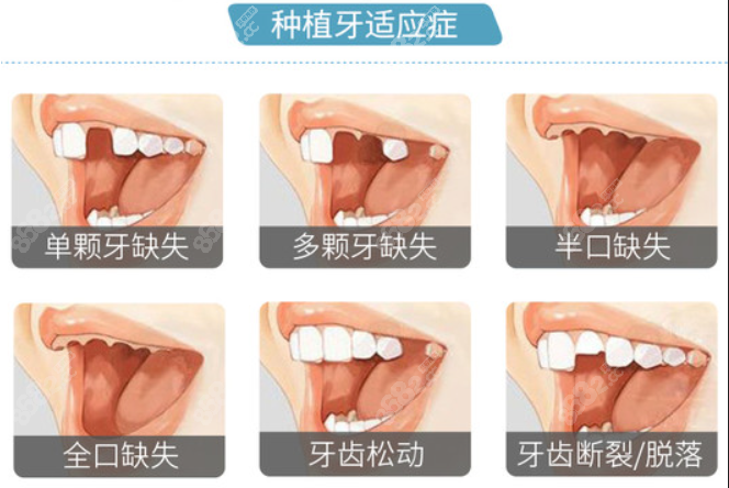 <!--<i data=20240705-sp></i>-->口腔种植牙可以改善口腔问题8682.cc