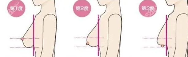 www.ekelt.cn長(zhǎng)沙做縮胸手術(shù)多少錢