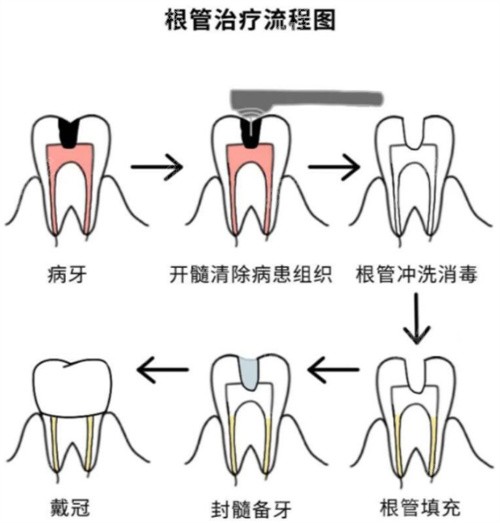 牙齿根管治疗流程图