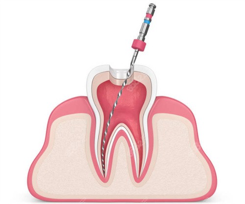 牙齿根管治疗示意图