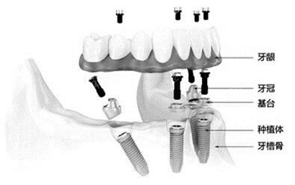 半口半固定种植牙结构图