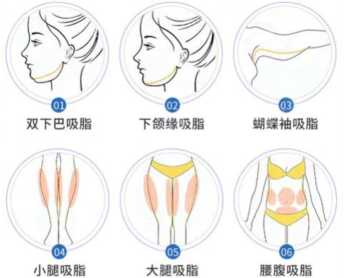 柳州腰腹吸脂多少钱m.8682.cc