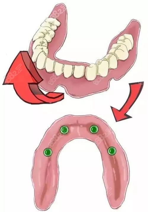 半口半固定种植牙如何固定