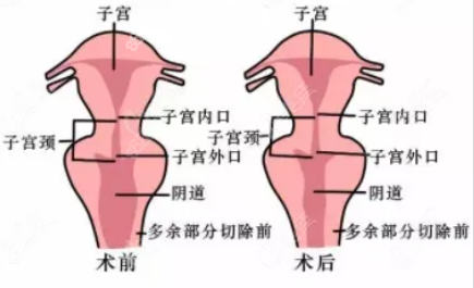 缩阴手术前后对比照片8682.cc