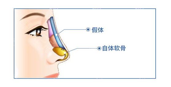 做鼻综合选耳软骨好还是肋软骨好