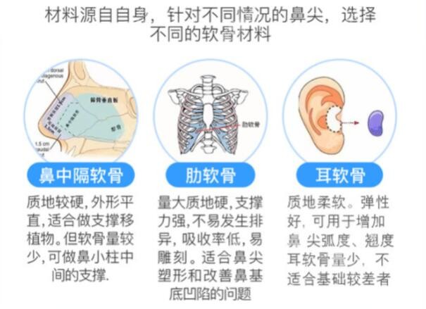 隆鼻材料分3种