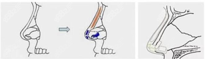 曹海峰做鼻子示意图