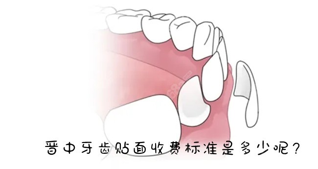 晋中牙齿贴面收费标准