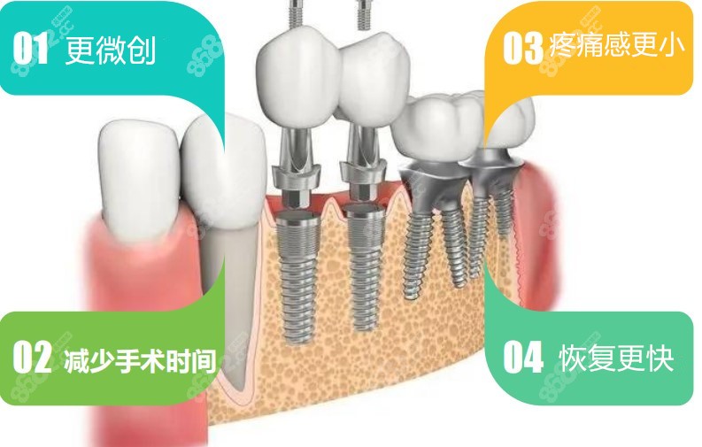 广州柏德口腔李懿种植牙技术特色