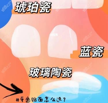 牙齿瓷贴面怎么选择材料