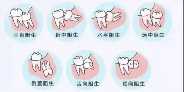 不同类型的阻生智齿