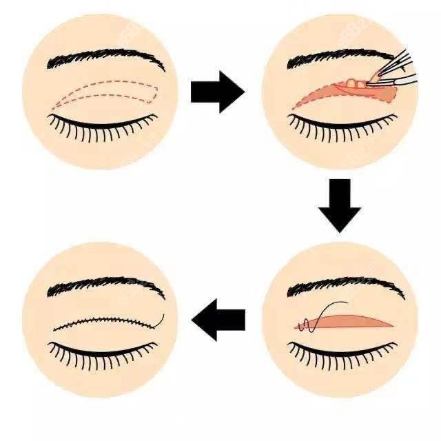 做全切双眼皮三年后肉条明显还硬,这种做修复的话需要.