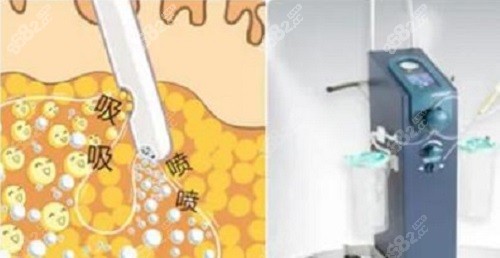 厦门欧菲医疗美容吸脂