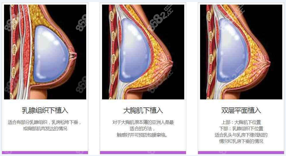 重庆当代牙祖蒙隆胸技术：“傲蜜美胸”