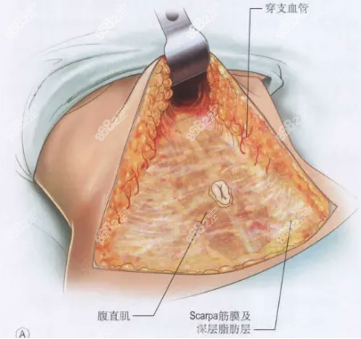 腹壁成型手术图片8682.cc