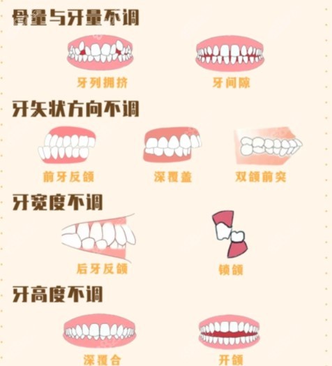 m.8682.cc牙颌畸形的分类