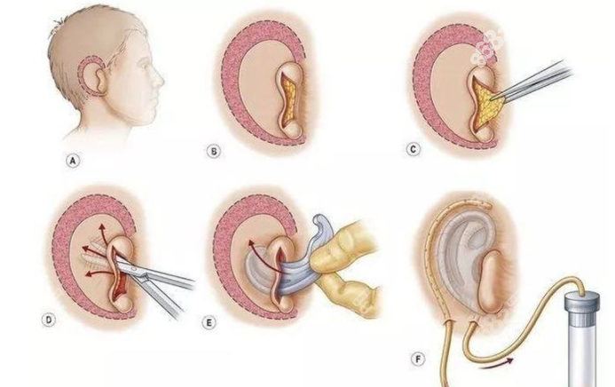 国内耳再造手术过程