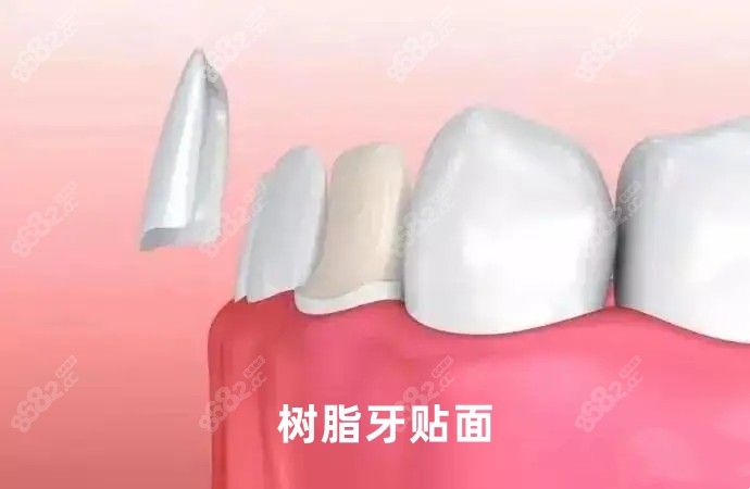 晋中做树脂牙贴面的样式