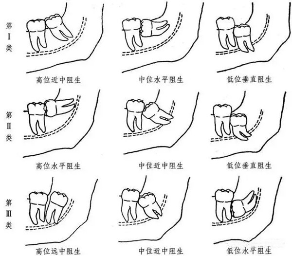 不同高位、低位阻生智齿图片