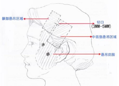 <!--<i data=20240705-sp></i>-->筋膜悬吊手术示意