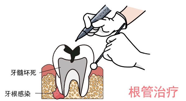医生不说的根管治疗秘密