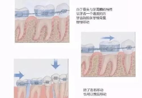 牙齿矫正原理