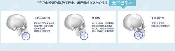 韩国菲斯莱茵faceline整形医院强项是什么