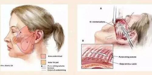 <!--<i data=20240705-sp></i>-->拉皮手术示意