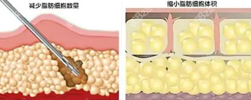 吸脂手术示意图