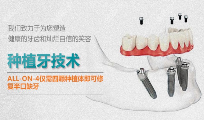 宜兴华齿口腔的半/全口种植牙技术